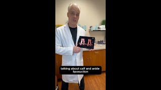 Calf & Ankle Liposuction Before & After | 20+ Years of Dr. Wright’s Expertise Cankle Liposuction Nightmare
