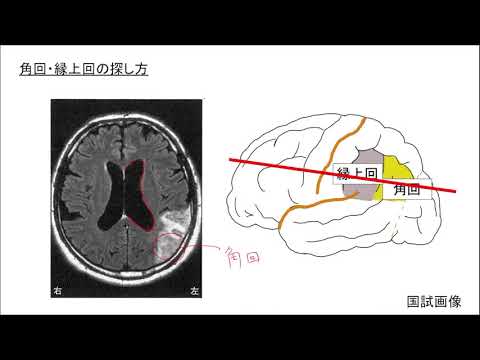 【脳画像の見方（角回・縁上回の機能、高次脳機能障害）】，脳血管障害　解剖・生理学　MRI　理学療法士国家試験・作業療法士国家試験　PT・OT・ST・看護師　＃理学療法士　＃作業療法士　＃国試