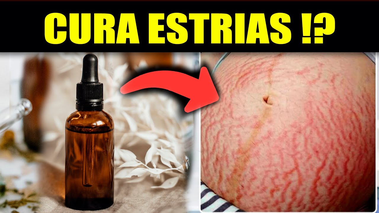 10 ÓLEOS VEGETAIS [MILAGROSOS] PARA ESTRIAS VERMELHAS E BRANCAS! - YouTube