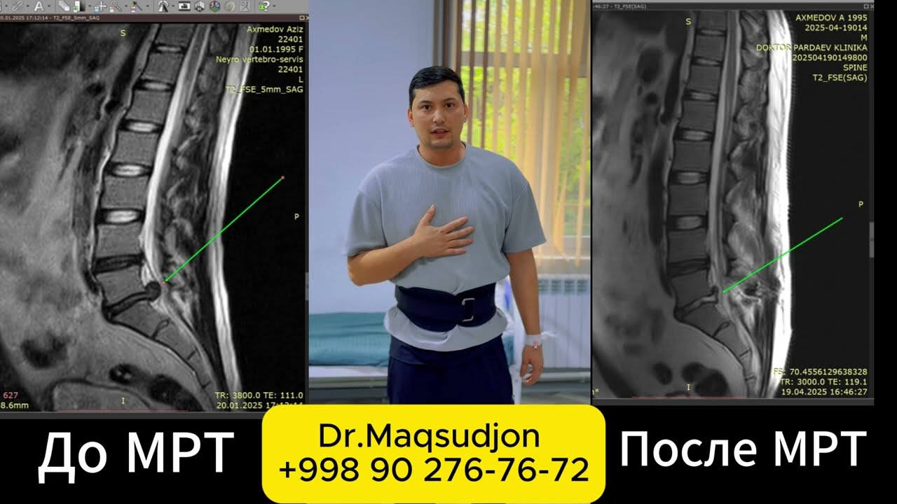 УМУРТКА ДИСК ГРЫЖАСИНИ КЕСМАСДАН ЭНДОСКОП (UBE/IL) ЛАЗЕР УСУЛИДА ОЛИБ ЖАРАЁНИ  +99890-276-76-72