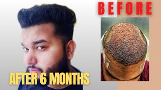 Hair Transplant Journey Slideshow Day 0 To 6 Months Best Hair Transplant In India 2019