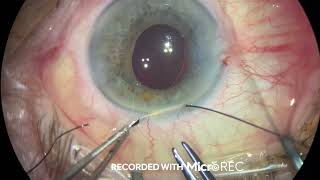 Live Surgery IV - Dr. Pau Romero - Deep Sclerectomy with Esnoper Clip Implant Technique