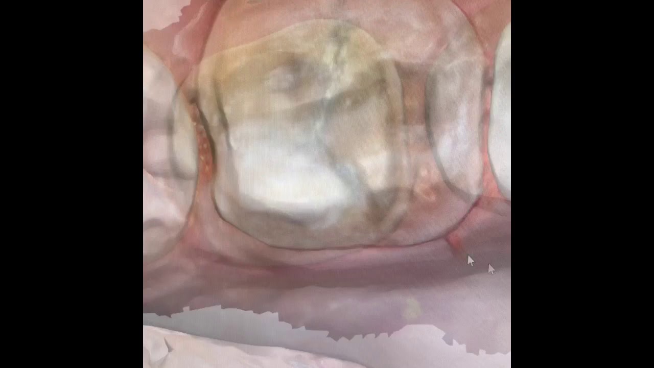 38Smiles Dental Lab: A perfect example of a digital scan using Medit
