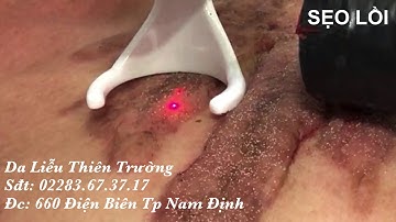 SẸO LỒI VÙNG NGỰC SIÊU TO KHỔNG LỒ