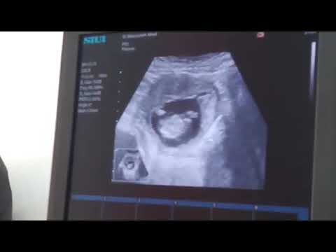 اخرین سونوگرافی برای دیده به جهان گشودن