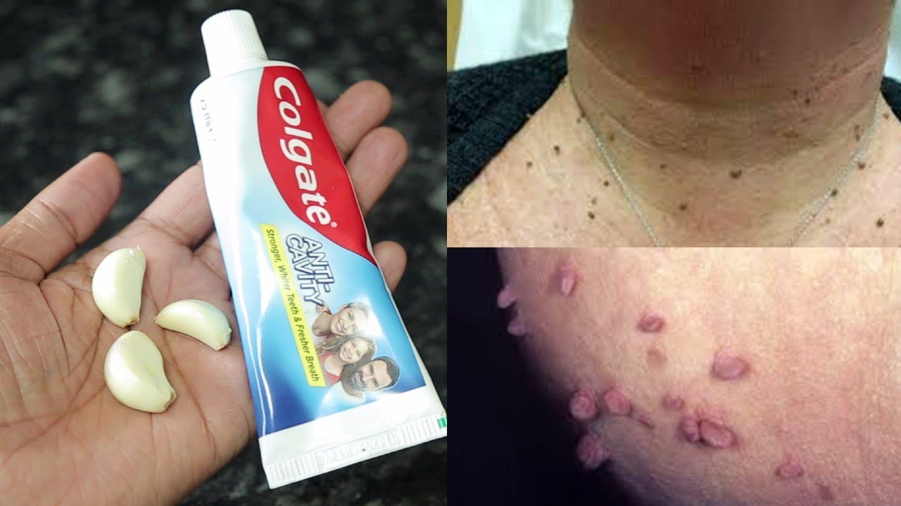 How to Remove Skin Tags and Warts Overnight | Moon Maker |