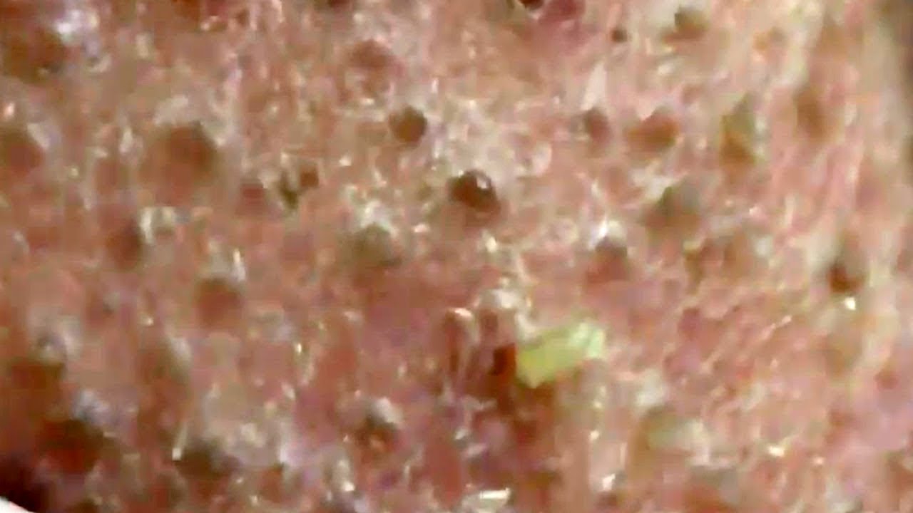 Blackheads And Milia Big Cystic Acne Blackheads Extraction Whiteheads