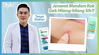 Menghilangkan Jerawat dengan Biaya Murah. Terbukti!