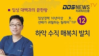 김영삼원장의 하악 수직매복 사랑니발치