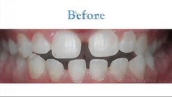Align Advantage Teen presented by Petrover Orthodontics
