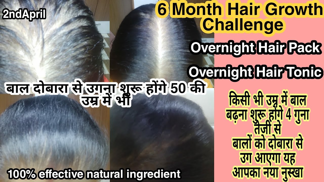 गज हन क बद जलद बल कस उगए  नए बल उगन क 10 घरल उपय 2023   how to grow hair after baldness in hindi  techhindiakv