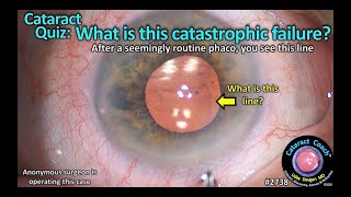 Cataractcoach 2738 Quiz What Is This Catastrophic Failure? Descemets Detachment