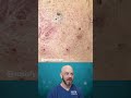 HUGE Blackhead Removal In This Video 亞 Credit Satisfy Pimple On TT Foryou Satisfying Blackhead HUGE Blackhead Removal In This Video 亞 Credit Satisfy Pimple On TT Foryou Satisfying Blackhead