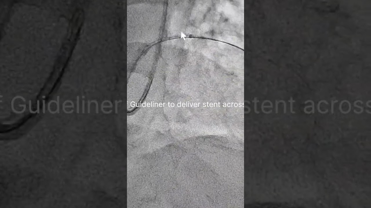 Case 21:Complex CTO revasc in 46 yr old..