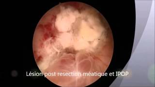 Prise en charge des cancers urologiques : la microscopie confocale laser
