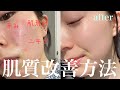 【ニキビ肌改善】肌荒れを治すためにした事と最強リピ買いスキンケアアイテム教えます。