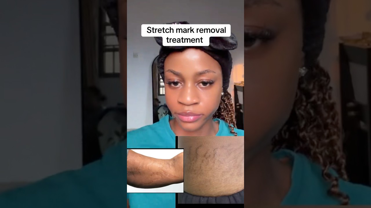 Stretchmark removal treatment 