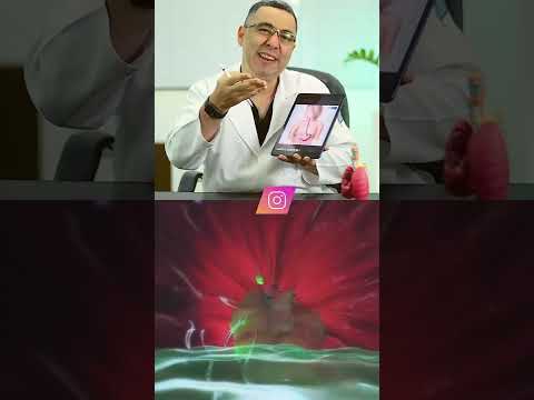 Refluxo gastroesofágico - Veja como ela age no seu corpo #Refluxo #gastroesofágico #pneumologista