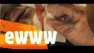 Mive Cyst Popping On Neck