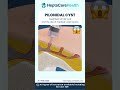 🔬 Laser Treatment for Pilonidal Cyst – Fast Relief with Zero Stitches at Heptacare!