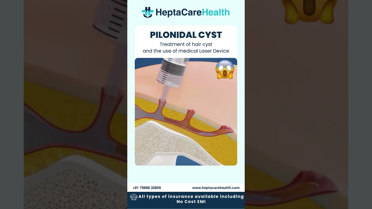🔬 Laser Treatment for Pilonidal Cyst – Fast Relief with Zero Stitches at Heptacare!