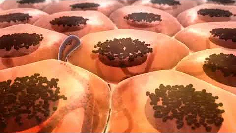 Melanoma | MOD Animation