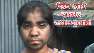 বিরল রোগে আক্রান্ত জামালপুরবাসী! | Jamalpurer Manush Birolo Roge Akroto