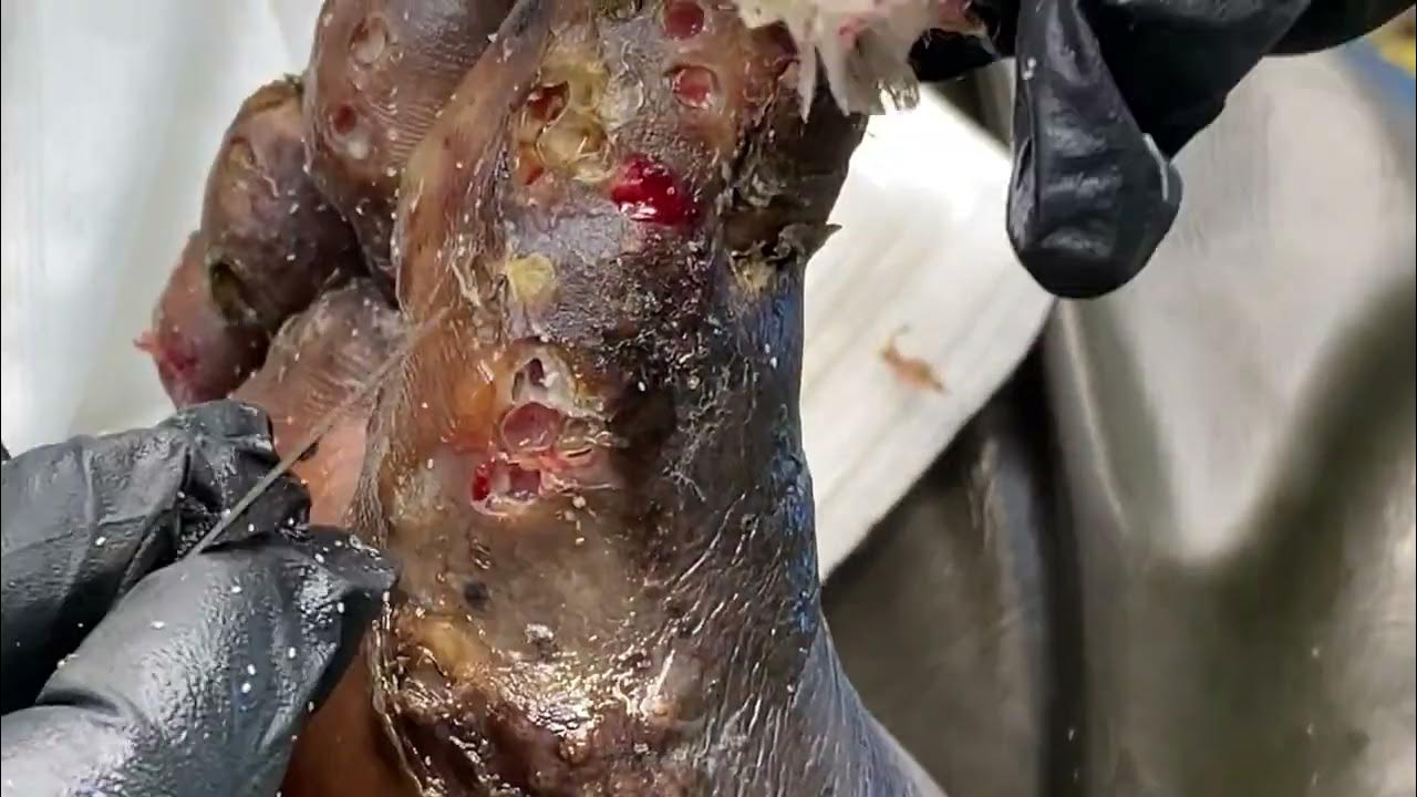 Jigger Digging Samuel's Right foot jiggers lined up on the side of the