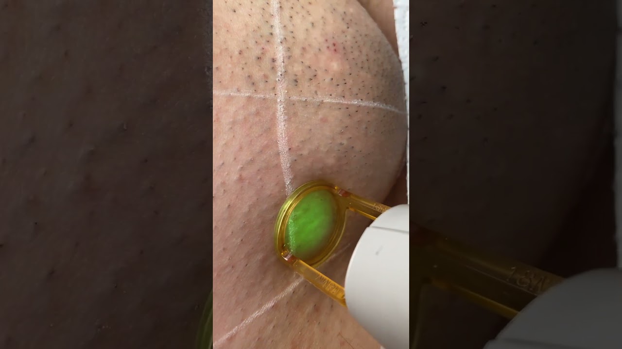 Satisfying Laser Hair Removal- Alexandrite Laser.