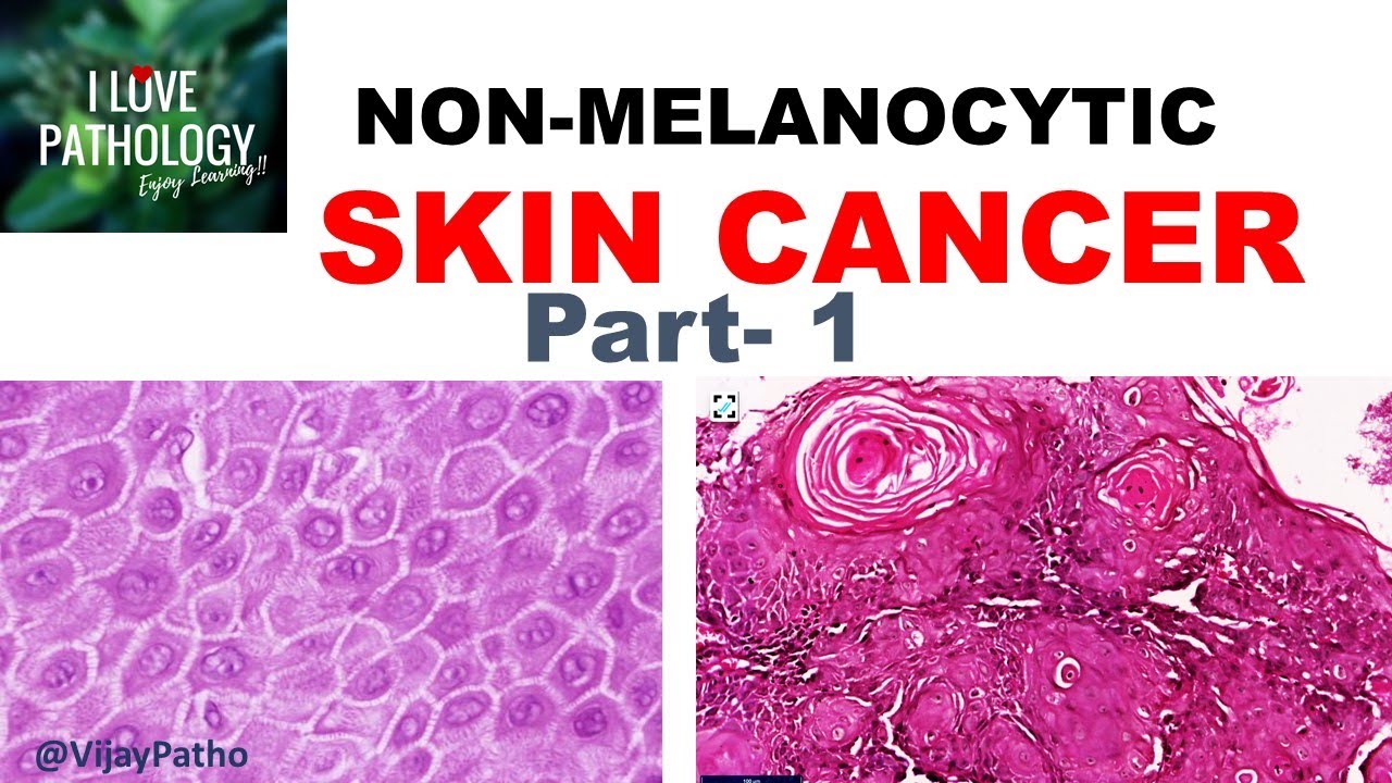 SKIN CANCER: Non Melanocytic: Part 1- Anatomy