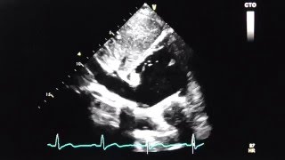 Vena cava inferior in subcostalem Blick (V.cava inferior subcostal view)