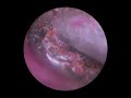 S02E05 - Complex Ear Drum Dry Skin Peel &amp; Reddish Orange Ear Wax Plugs Cleaning. EarWax Removal.