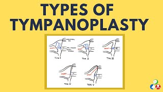 Types of Tympanoplasty with Diagrams - Wullstein Classification | ENT Made Easy