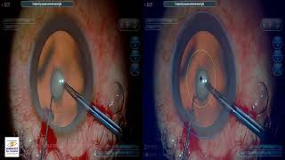 PPC 3D Dr Sourabh Patwardhan Live Cataract surgery. For training and consultation call 9220001000