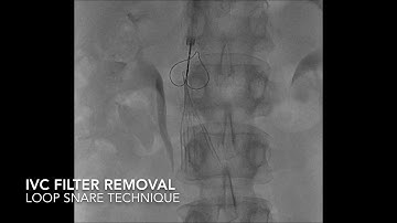 Simple IVC Filter Removal
