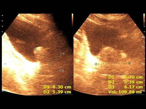 Ultrasound cases 218 of 2000 || Grossly enlarge prostate || Benign prostatic hyperplasia