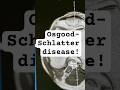 OSD in kids! #science#health#nurse#nurses#learn #teach#education#school#college#nclex #shorts