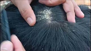 Scratching and removing dry scalp flakes satisfying ASMR #E180