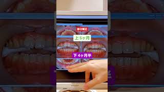 【前歯の部分矯正Mori Dental Clinic】#部分矯正 #前歯矯正 #前歯の部分矯正 #上5ヶ月 #下4ヶ月半 #歯並び矯正 #shorts #歯列矯正 #歯科矯正 #矯正歯科 #前歯