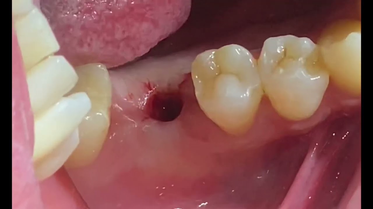 The X incision. DrEhabRashed for emergence profile - YouTube