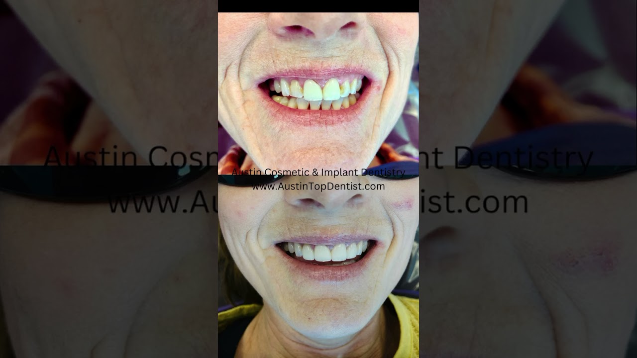 Rediscover the joy of a vibrant smile with Austin Cosmetic & Implant Dentistry