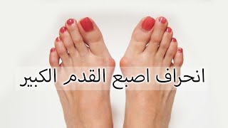 انحراف اصبع القدم الكبير - Hallux Valgus