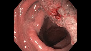 EUS/NBI for T1/NICE 3 rectal lesion not suitable for ESD
This case was referred for ESD. However, NBI and EUS evaluation indicated deep submucosal invasion. EUS/NBI for T1/NICE 3 rectal lesion not suitable for ESD