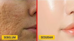 2 CARA MENGATASI BOPENG BEKAS JERAWAT DAN MENGECILKAN PORI-PORI WAJAH SECARA ALAMI || SEHAT TUBE - Durasi: 4.07. 