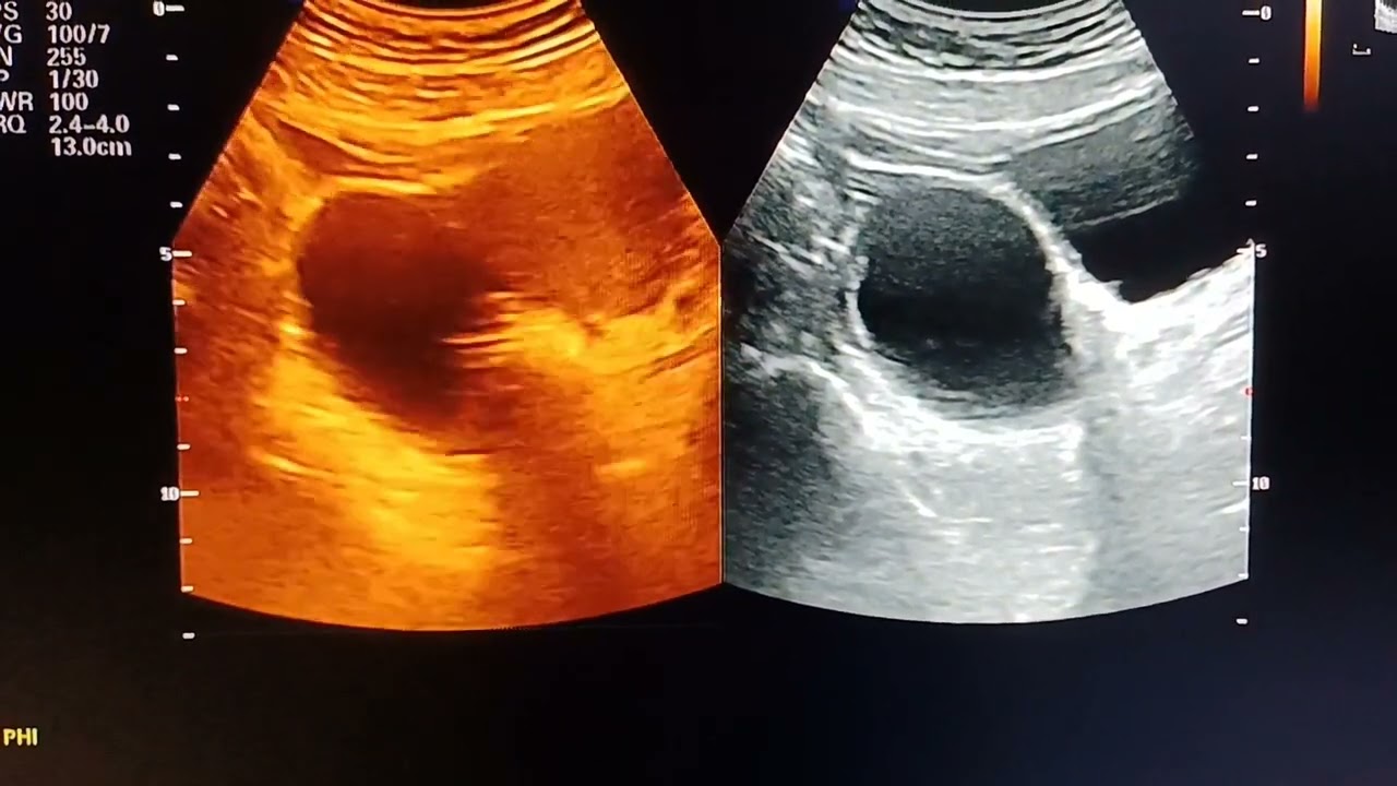 Irregular Period Pelvic Pain And Bleeding You May Have This Ovarian Irregular Period Pelvic Pain And Bleeding You May Have This Ovarian