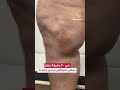 كابوس دوالي الساقين اختفى في دقائق بدون جراحة أو مضاعفات