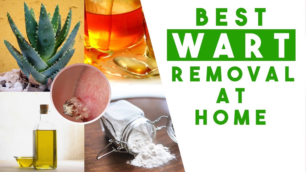 Best Wart Removal At Home YouTube