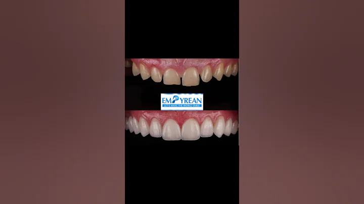 Smile Transformation with Veneers | Smile Design #shorts # #viralvideo  #trending #smilemakeover