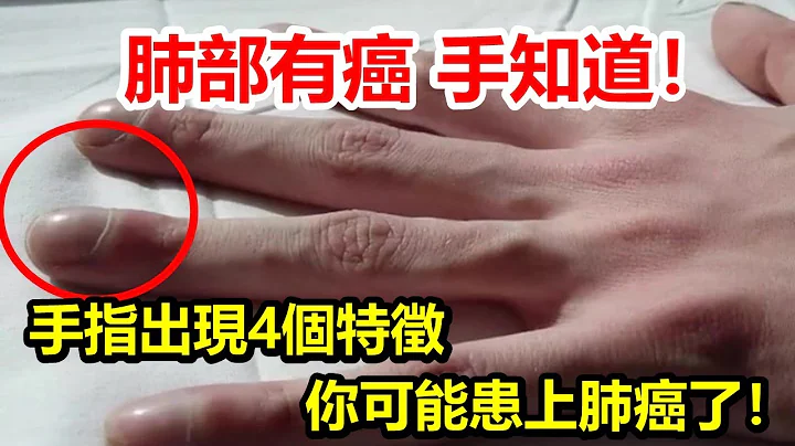 肺部有癌，手知道！手指若出現4個特徵，你可能患上肺癌了！千萬不要忽視了！ - 天天要聞