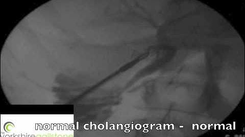 on table cholangiogram
